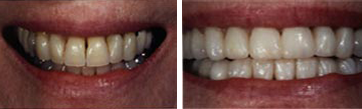 full mouth reconstruction newport beach dentist