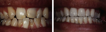 full mouth reconstruction newport beach dentist