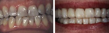 full mouth reconstruction newport beach dentist