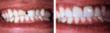 full mouth reconstruction newport beach dentist